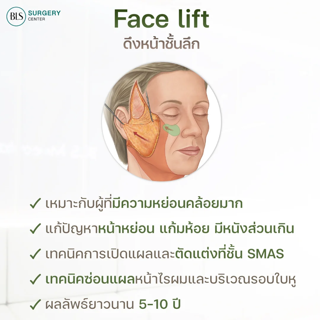 เทคนิคการดึงกระชับลึกถึงชั้น SMAS | ศัลยกรรมดึงหน้า