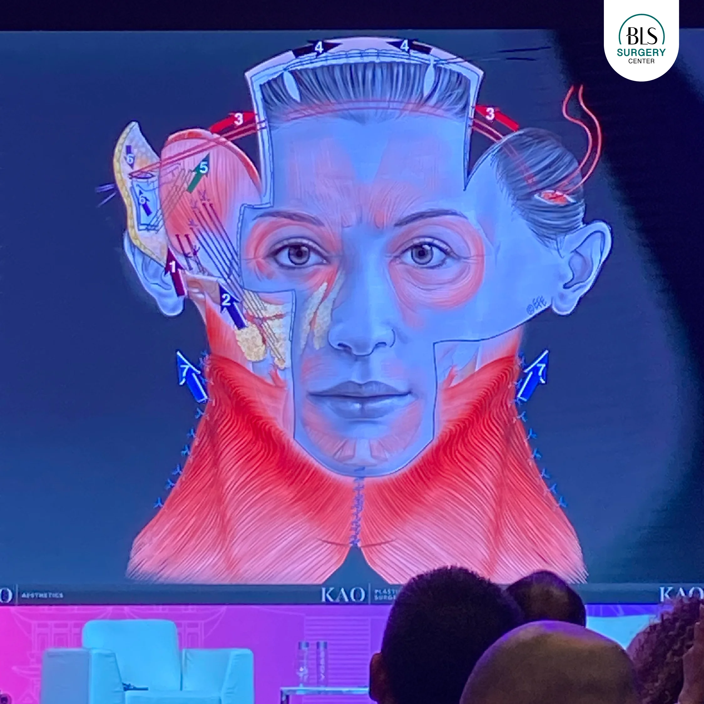 บรรยากาศงาน ISAPS 2025 บรรยายหัวข้อเทคนิคการดึงหน้า Face Lift