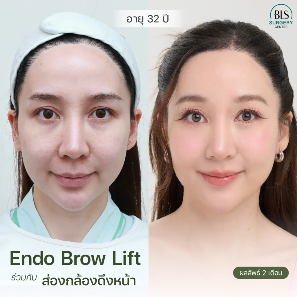 ผลลัพธ์หลังทำ Endo-Brow Lift และ Endo-Face Lift ที่ BLS