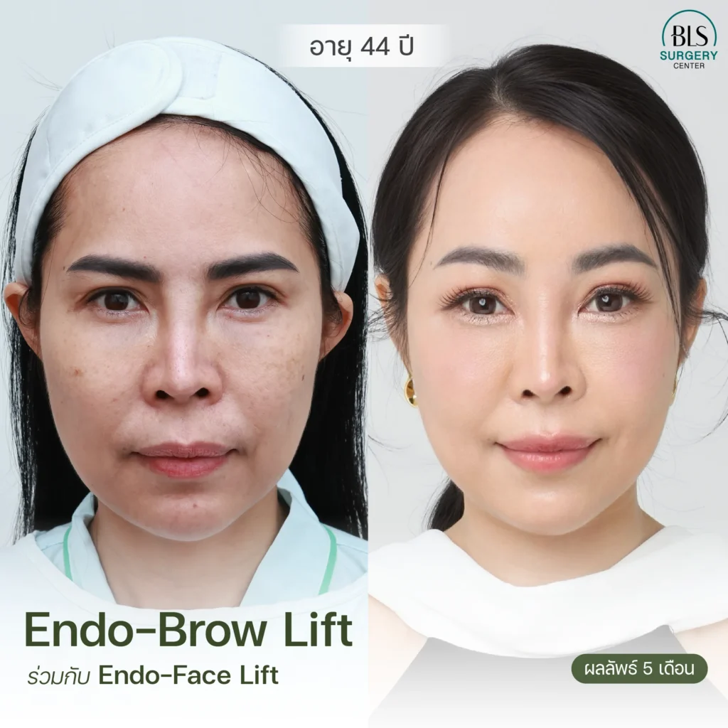 ผลลัพธ์หลังทำ Endo-Brow Lift และ Endo-Face Lift ที่ BLS