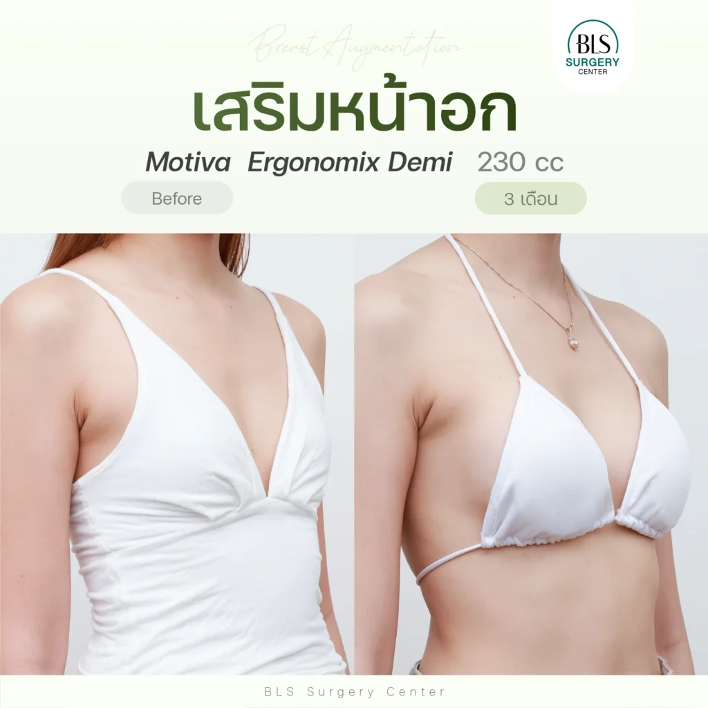 ผลลัพธ์หลังส่องกล้องเสริมหน้าอก ที่ BLS
