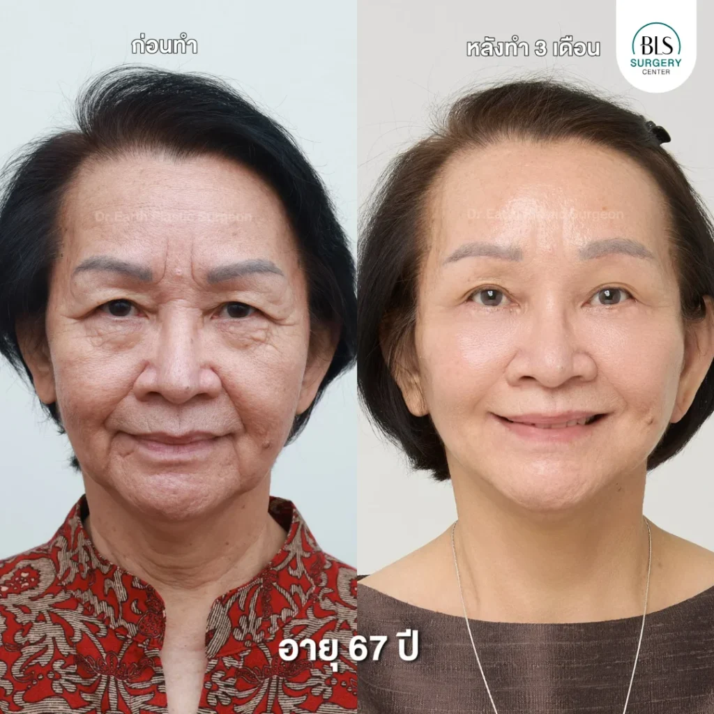 ผลลัพธ์หลังยกกระชับใบหน้า ย้อนวัย ที่ BLS Surgery Center