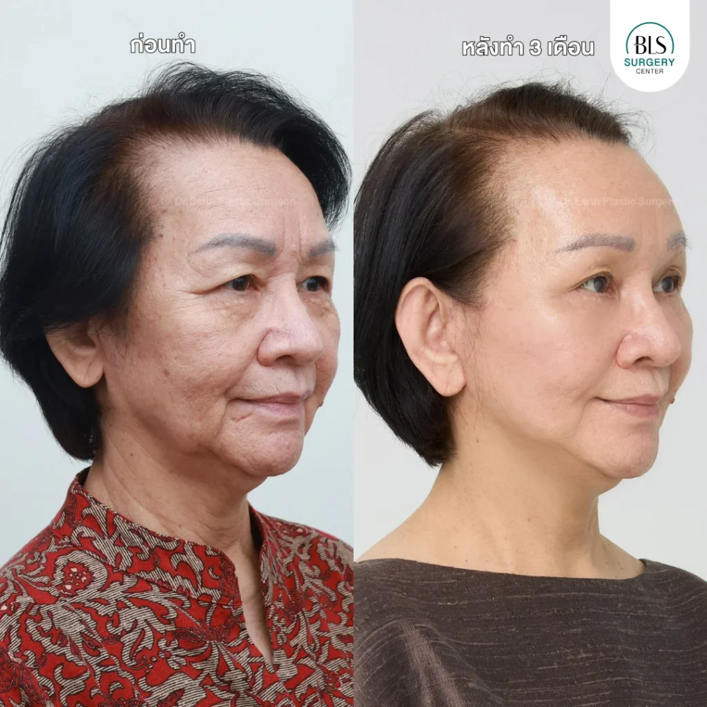 ผลลัพธ์หลังยกกระชับใบหน้า ย้อนวัย ที่ BLS Surgery Center