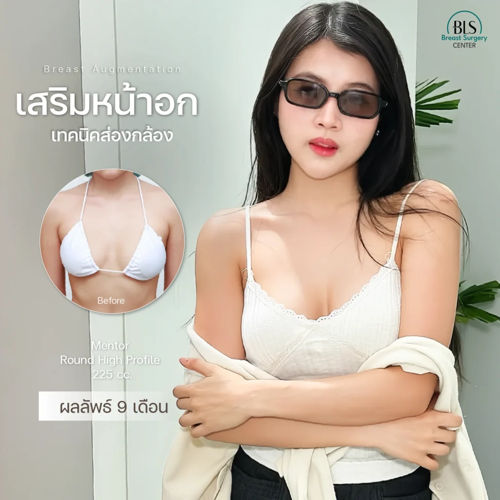 รีวิวศัลยกรรมหน้าอก ยกกระชับผิว ที่ BLS Suergery Center