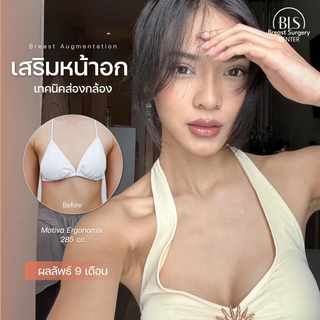 รีวิวศัลยกรรมหน้าอก ยกกระชับผิว ที่ BLS Suergery Center