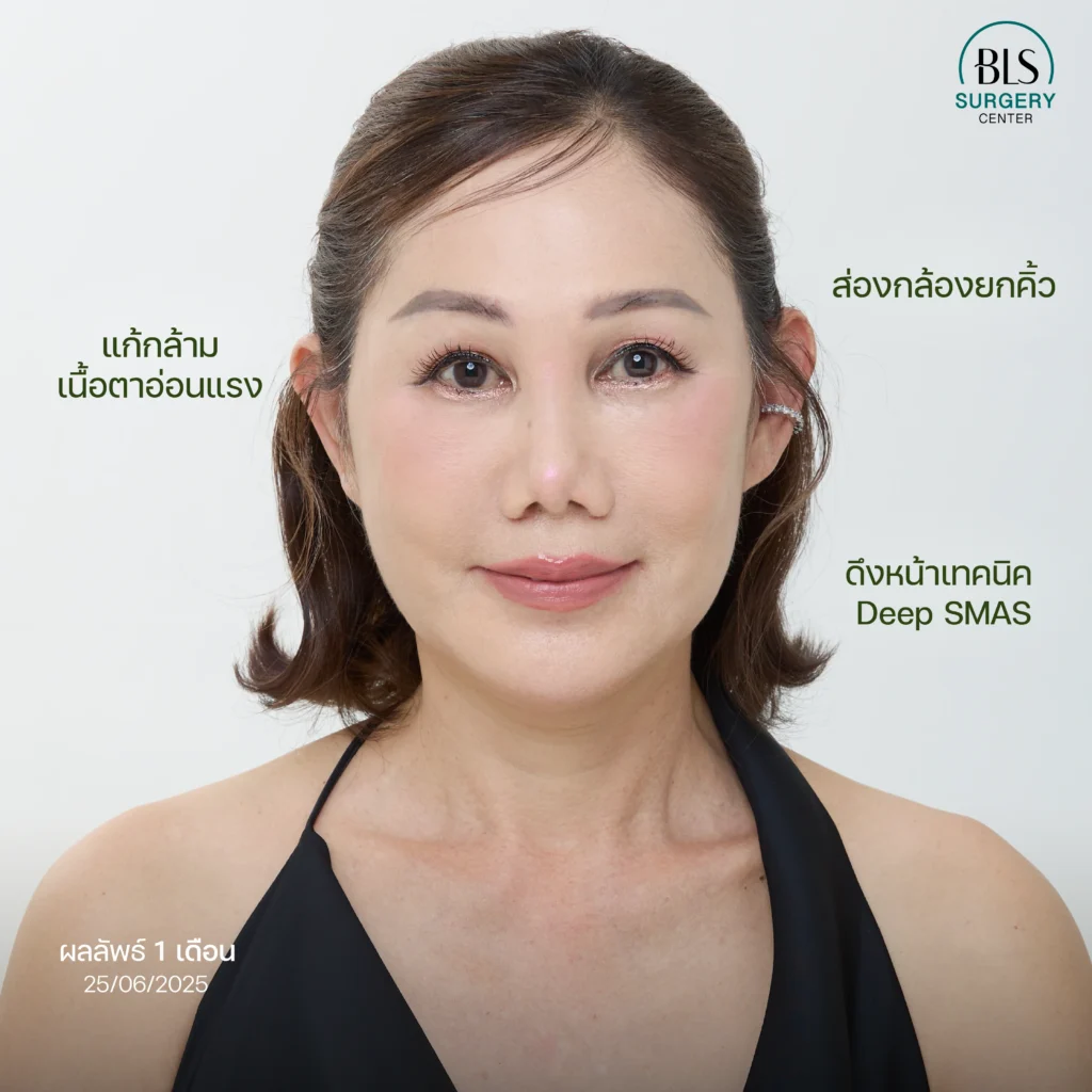 เคส Endotine ยกคิ้ว ร่วมกับดึงหน้าและแก้กล้ามเนื้อตาอ่อนแรง