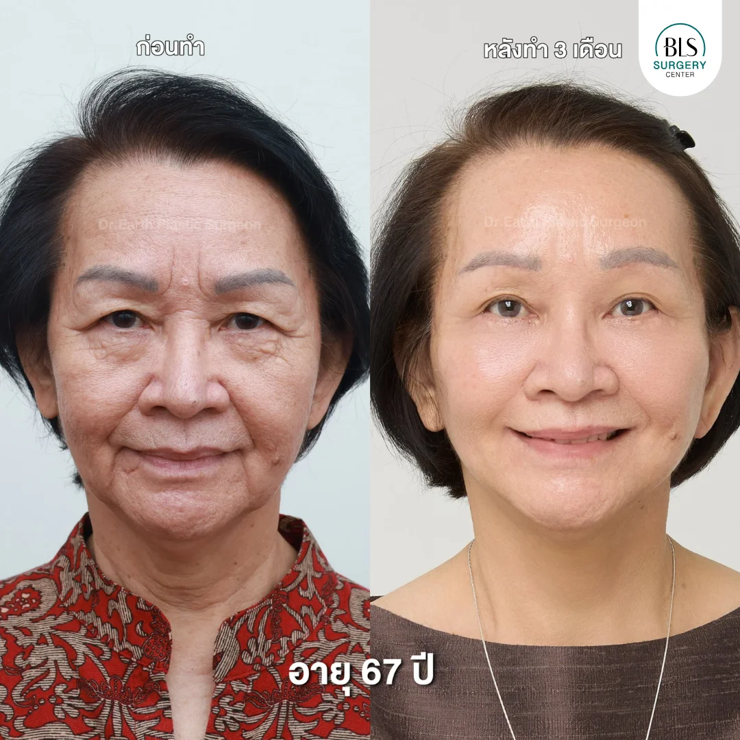 เคสดึงหน้าดึงคอ ยกกระชับผิว ยกกระชับย้อนวัย ที่ BLS