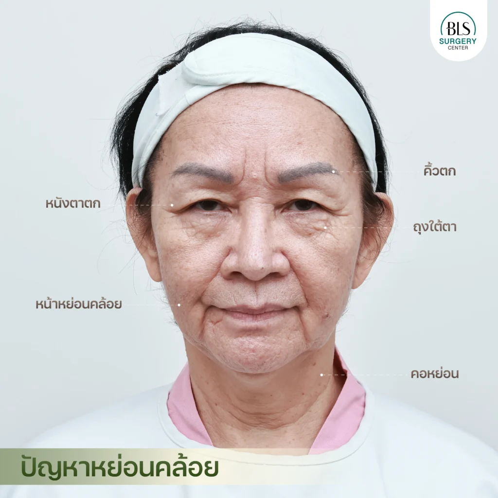 เคสดึงหน้าดึงคอ ร่วมกับการส่องกล้องยกคิ้ว ยกหนังตาและตัดถุงใต้ตา