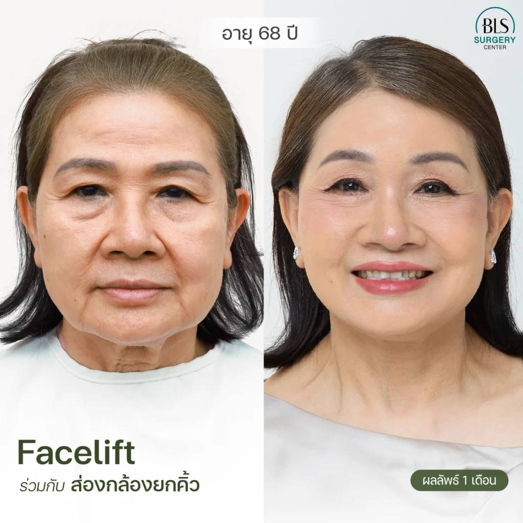 รีวิวศัลยกรรมย้อนวัย ยกกระชับผิว ที่ BLS Suergery Center