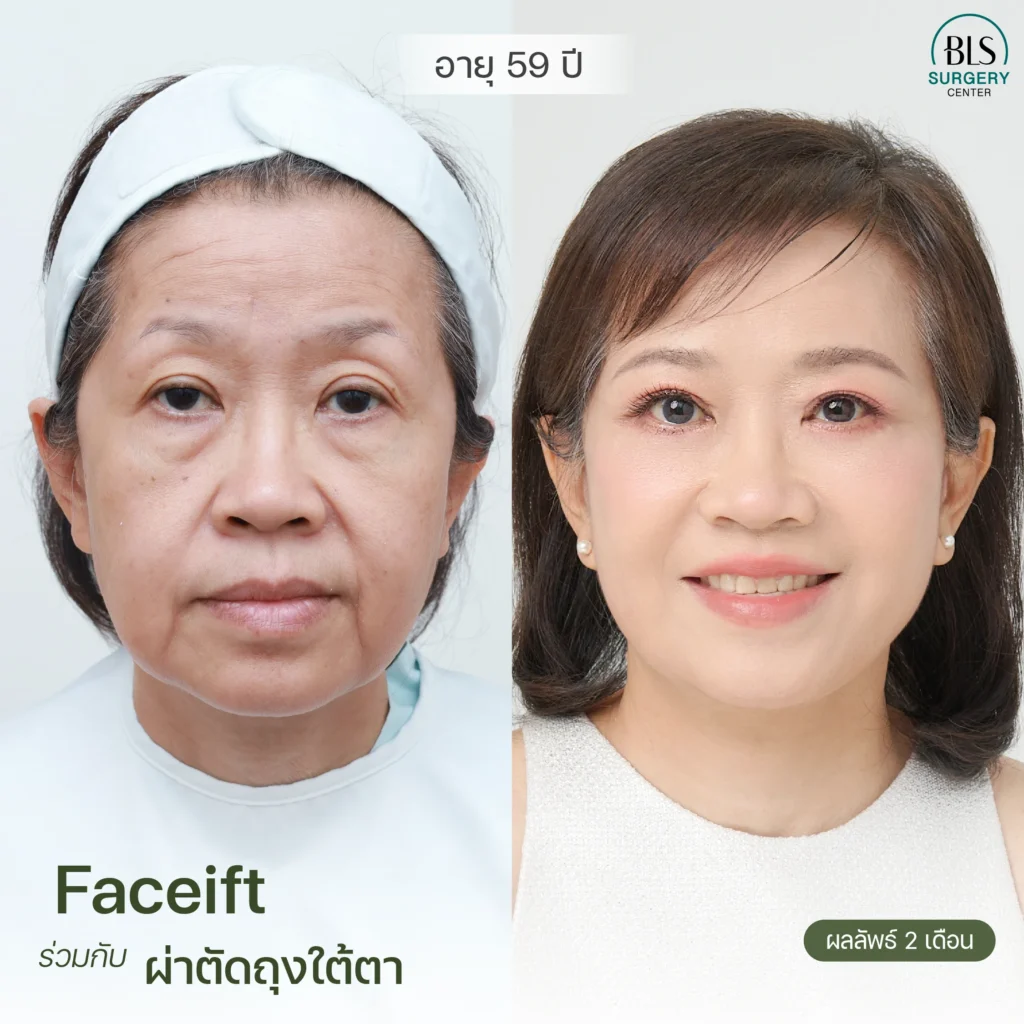 ชมเคสศัลยกรรมย้อนวัย ดึงหน้า  Endotine ยกคิ้ว ผลลัพธ์ธรรมชาติ ที่ BLS Surgery Center