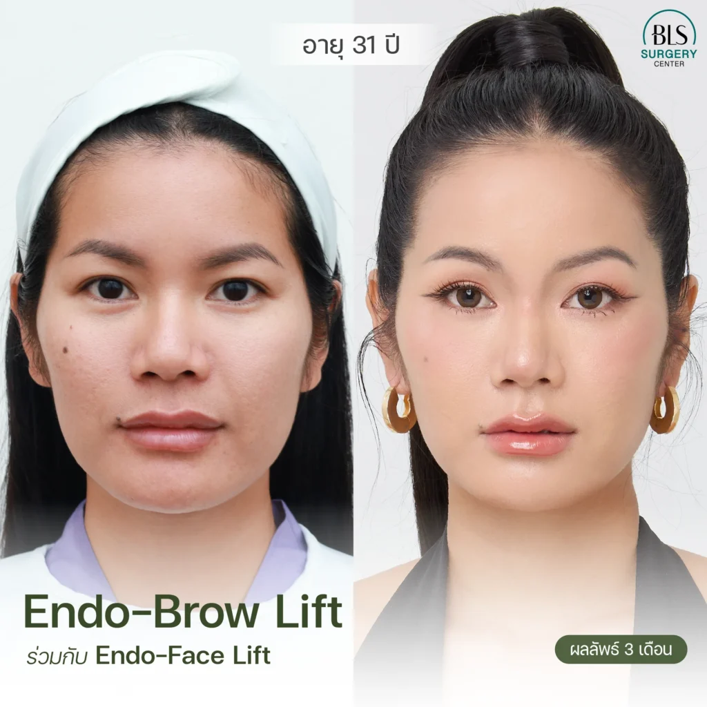 รวมเคสรีวิวยกคิ้ว Endotine สวยๆ ผลลัพธ์ธรรมชาติ ที่ BLS Surgery Center