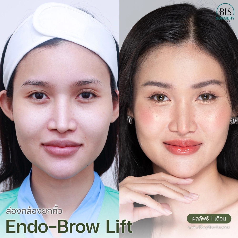 รีวิวศัลยกรรมใบหน้า ที่ BLS Surgery Center