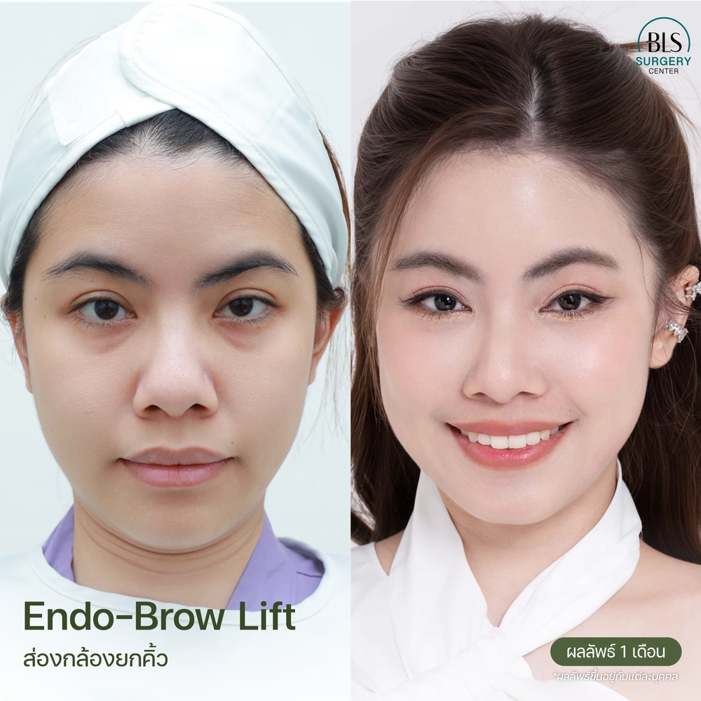 รีวิวศัลยกรรมใบหน้า ที่ BLS Surgery Center