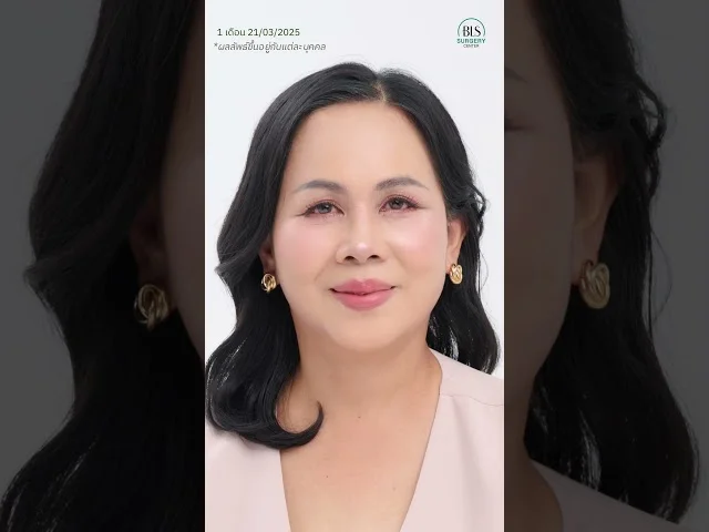 ศัลยกรรมดึงหน้าย้อนวัย ให้ผลลัพธ์เป็นธรรมชาติเป็นอย่างไร?