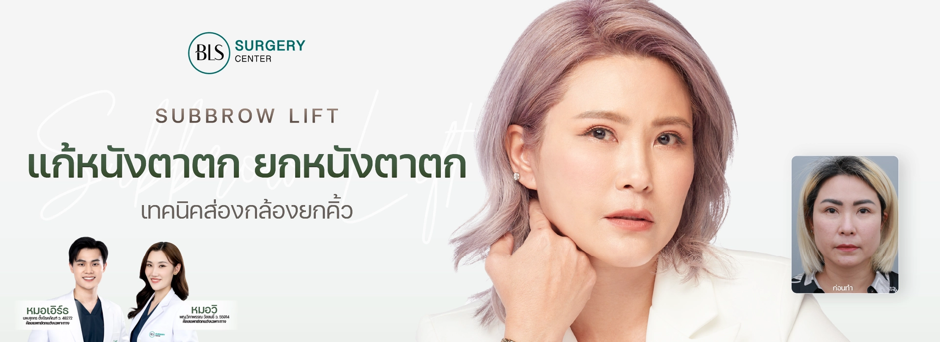แก้หนังตาตก และหางตาตก Sub Brow Lift