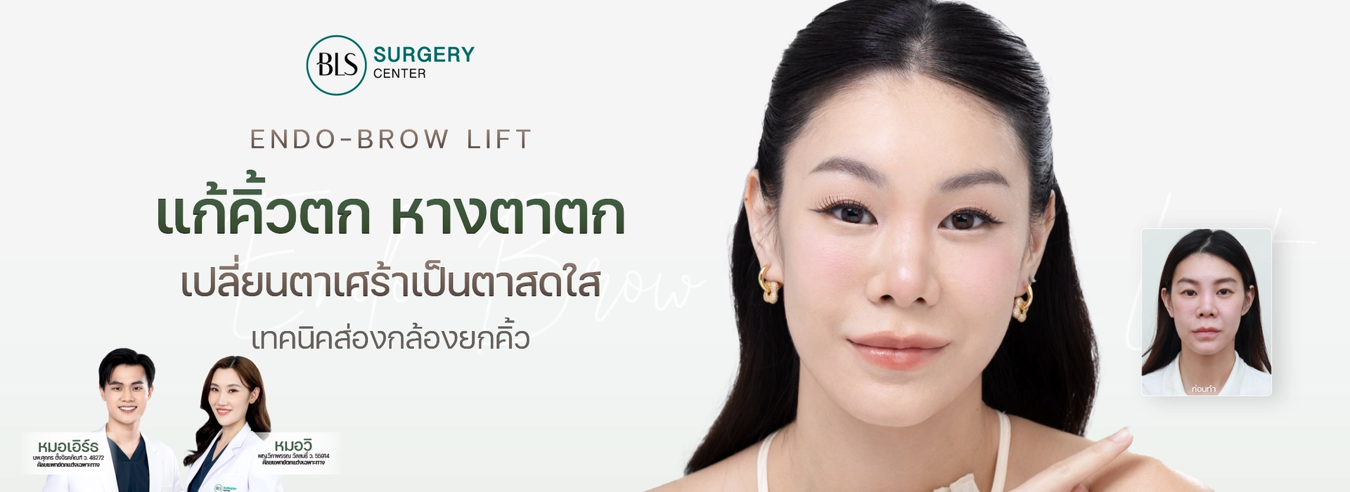 แก้คิ้วตก ตาตก ส่องกล้องยกคิ้ว Endobrow Lift