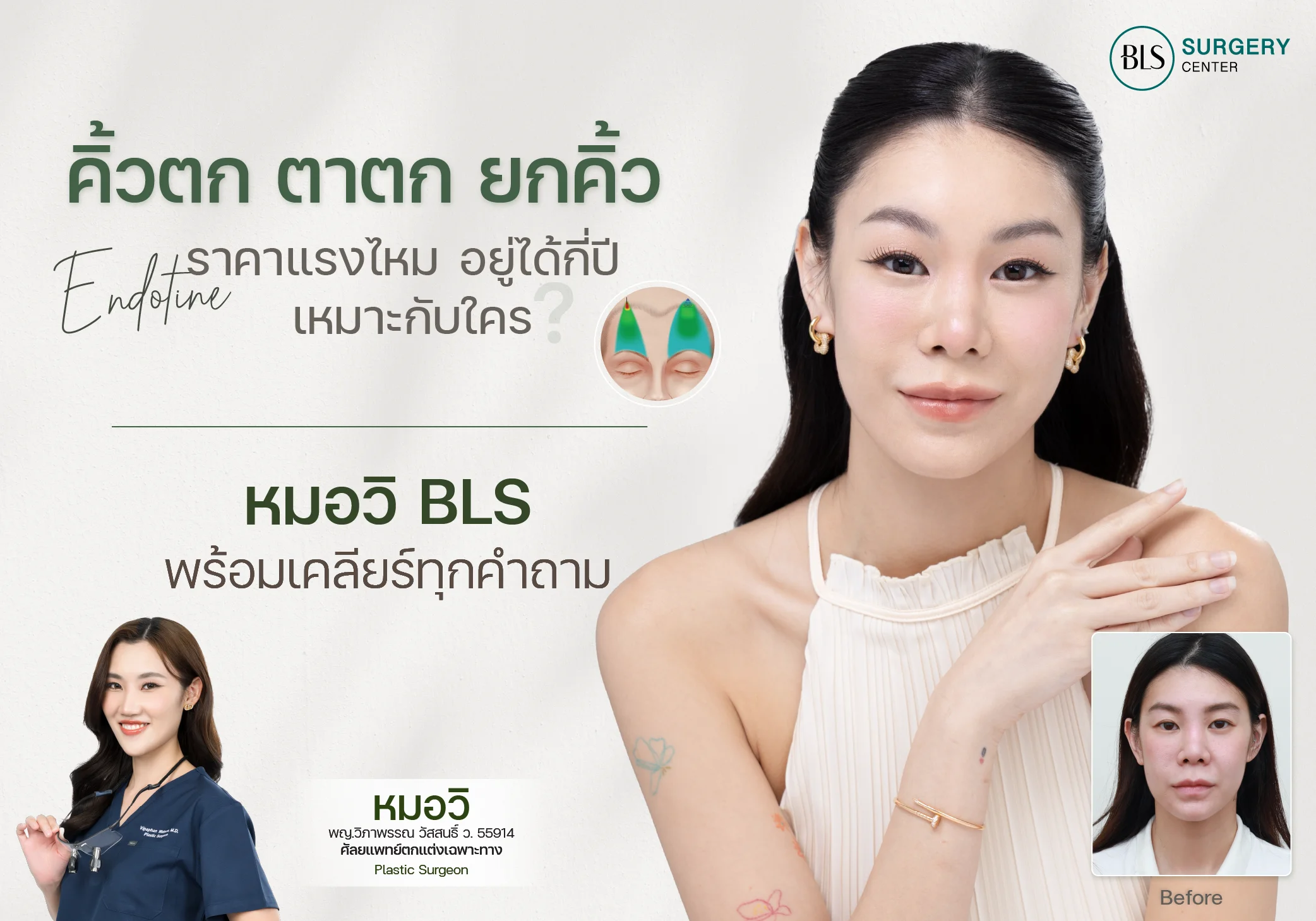 คิ้วตก ตาตก ยกคิ้ว Endotine ราคาแรงไหม? เหมาะกับใคร? อยู่ได้กี่ปี? หมอวิ BLS พร้อมเคลียร์ทุกคำถาม