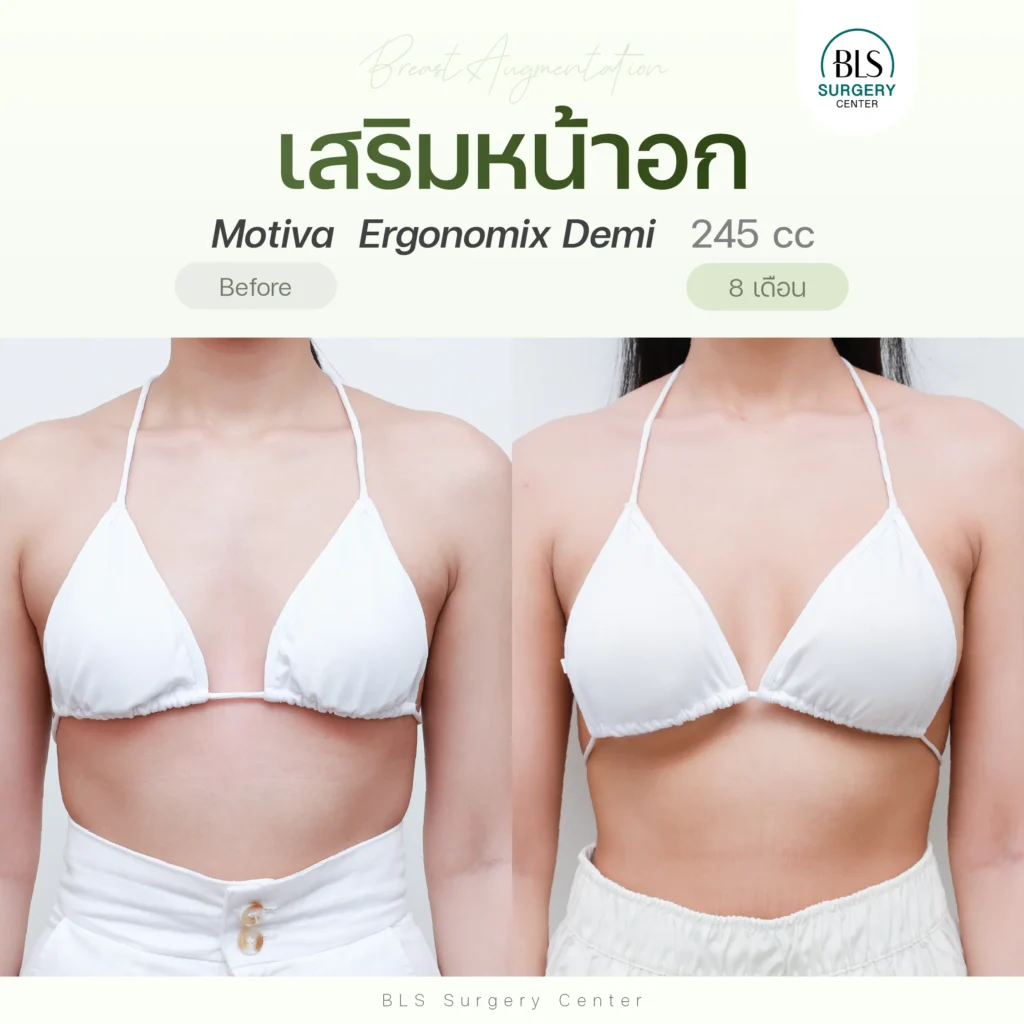 เสริมหน้าอก Motiva Ergonomix Demi 245 cc