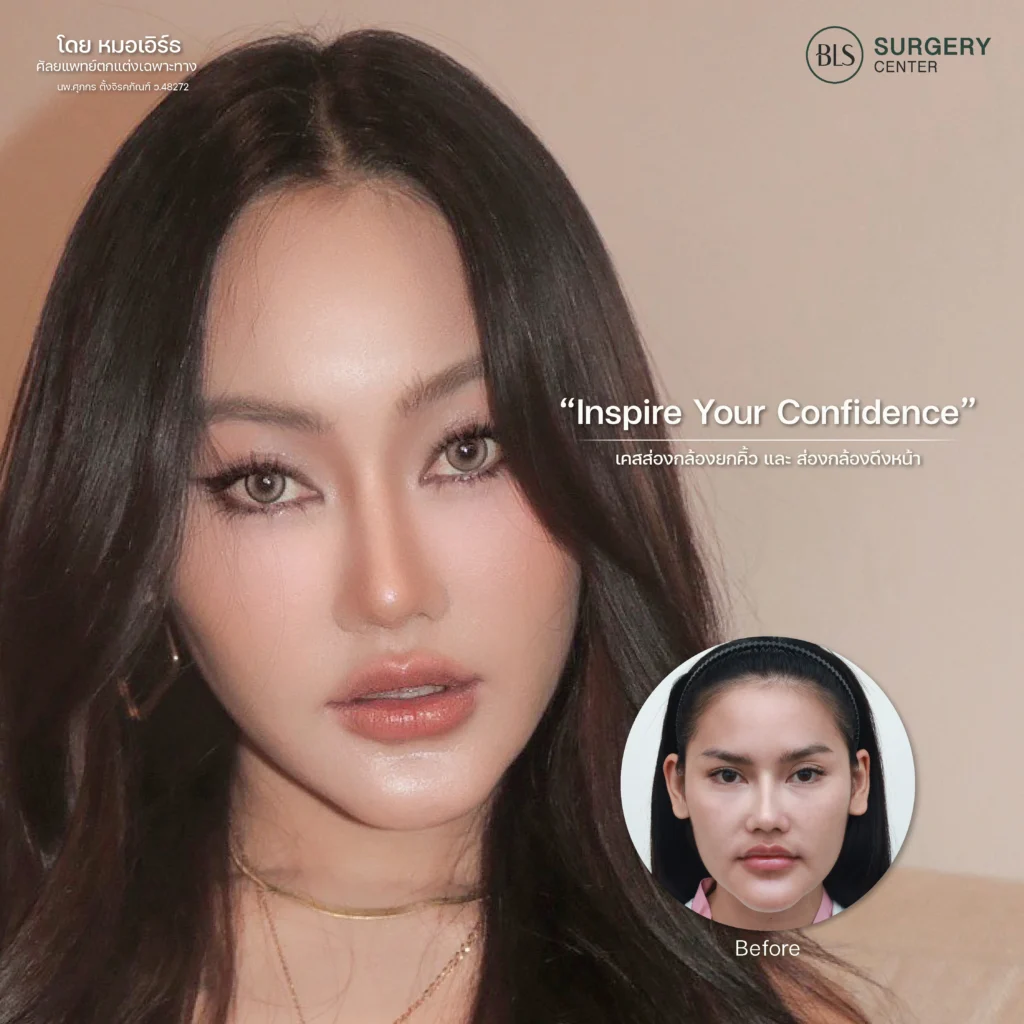 ผลลัพธ์ หลังส่องกล้องยกคิ้ว Endo-Brow Lift ที่ BLS