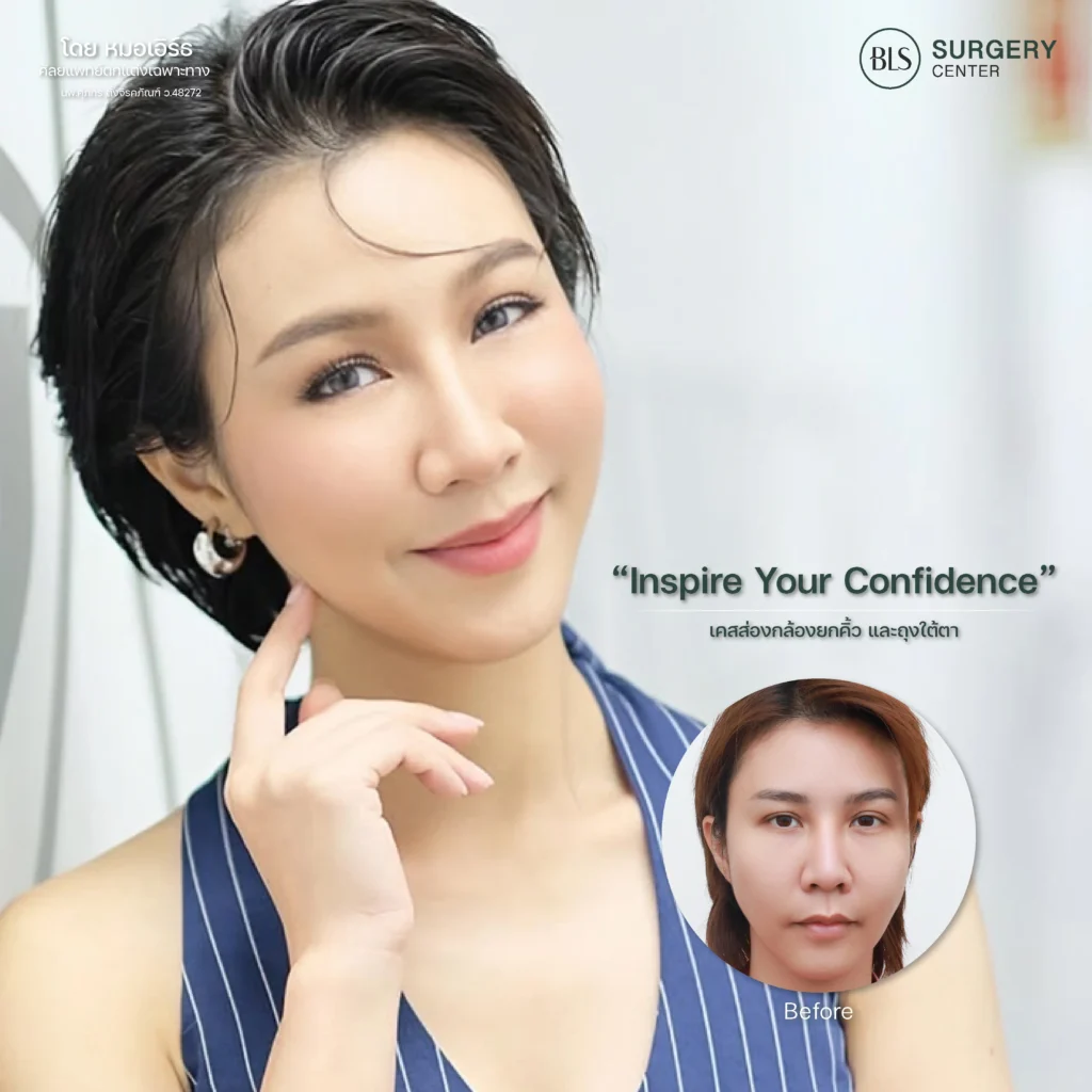 ผลลัพธ์ หลังส่องกล้องยกคิ้ว Endo-Brow Lift ที่ BLS