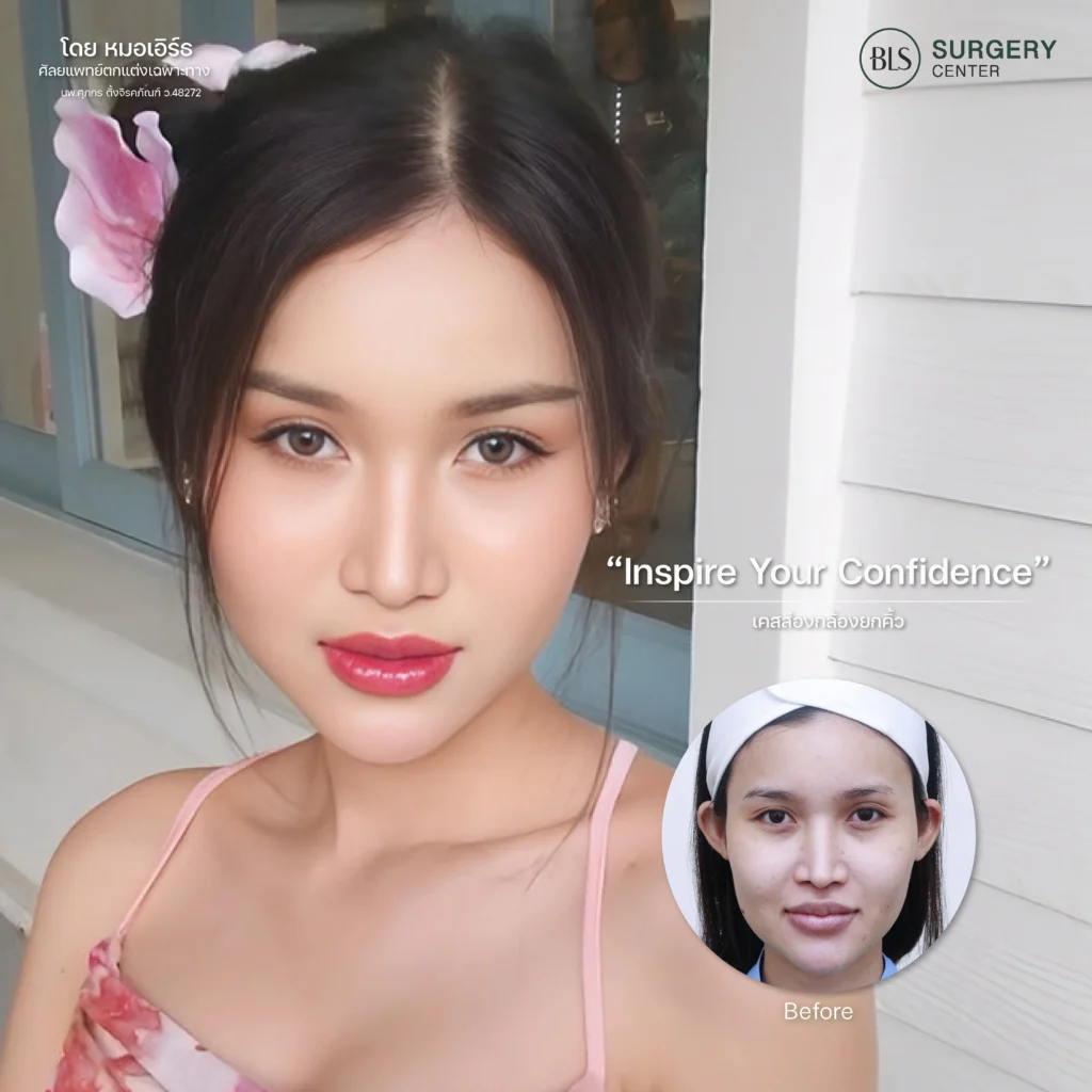 ผลลัพธ์หลังยกคิ้ว Endotine ที่ BLS Surgery Center