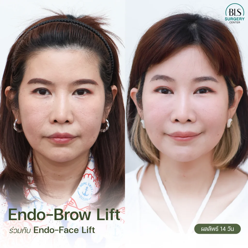 รวมเคสรีวิวยกคิ้ว Endotine สวยๆ ผลลัพธ์ธรรมชาติ ที่ BLS Surgery Center