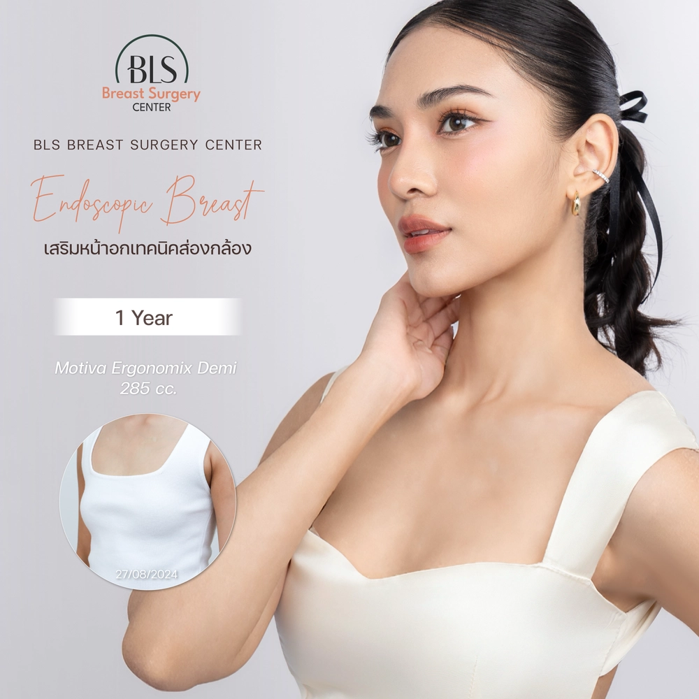 รีวิวเสริมหน้าอก breast augmentation