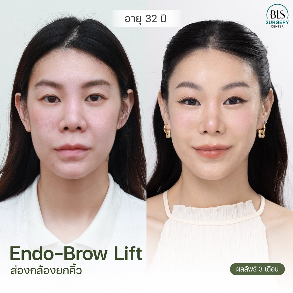 รีวิวส่องกล้องยกคิ้ว endo brow lift