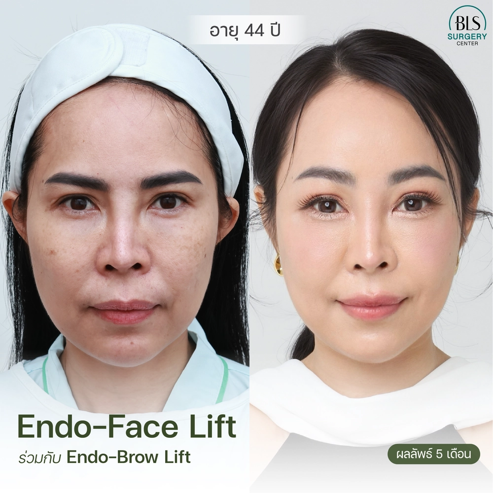 รีวิวส่องกล้องดึงหน้า endo face lift