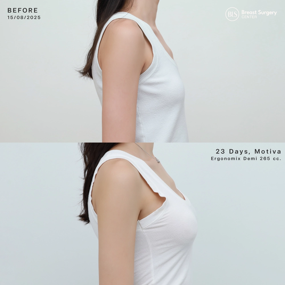 ปัญหาก่อนทำ หน้าอกแบน รูปร่างดูไม่ได้สัดส่วน หลังเสริมหน้าอกซิลิโคน Motiva Ergonomix Demi 265 cc ช่วยเพิ่มขนาดทรวงอก หน้าอกดูอิ่มเอิบ ลุคคุณหนู พร้อมรูปร่างที่ดูดี มีสัดส่วนที่ดีขึ้นอย่างเป็นธรรมชาติ