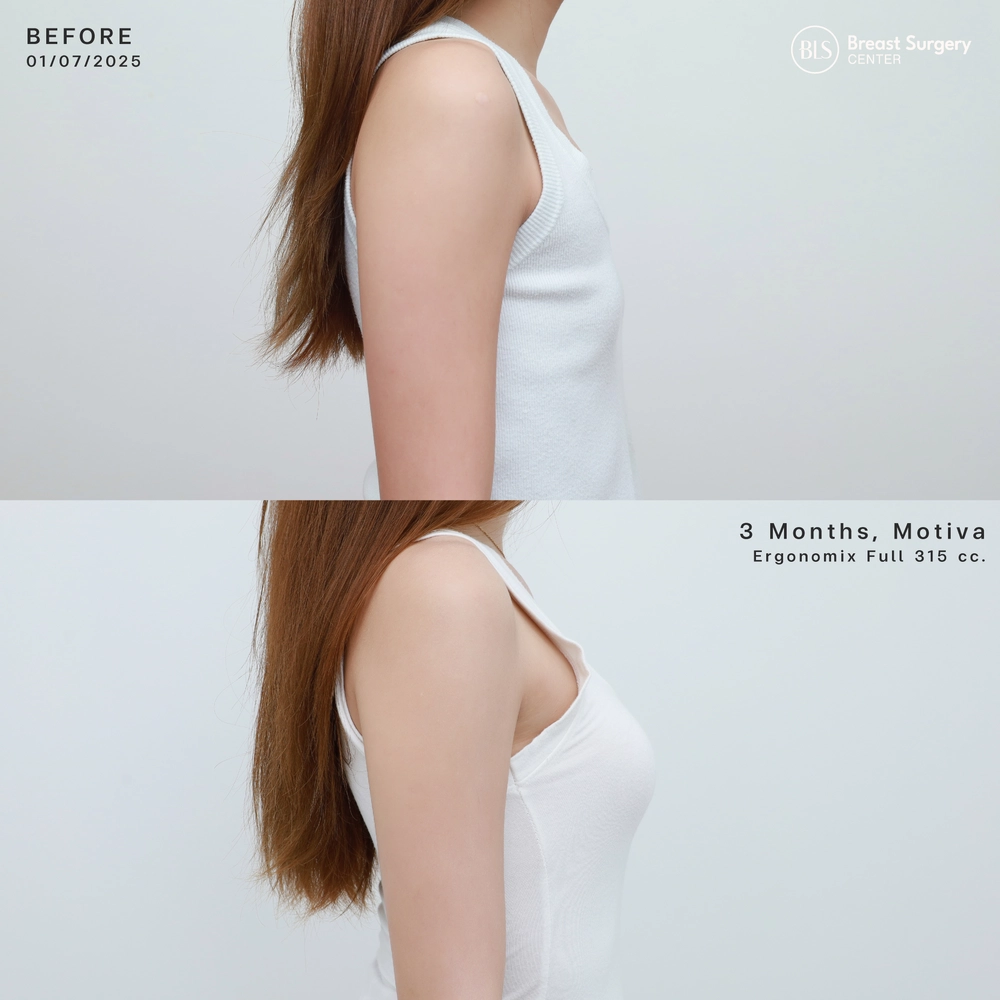 ปัญหาก่อนทำ รูปร่างเล็ก ทำให้หน้าอกเล็กตามไปด้วย หลังเสริมหน้าอกซิลิโคน Motiva Ergonomix Full 315 cc ทำให้รูปร่างสมส่วน ดูดีมากขึ้น ทรงหน้าอกสวยดูธรรมชาติ