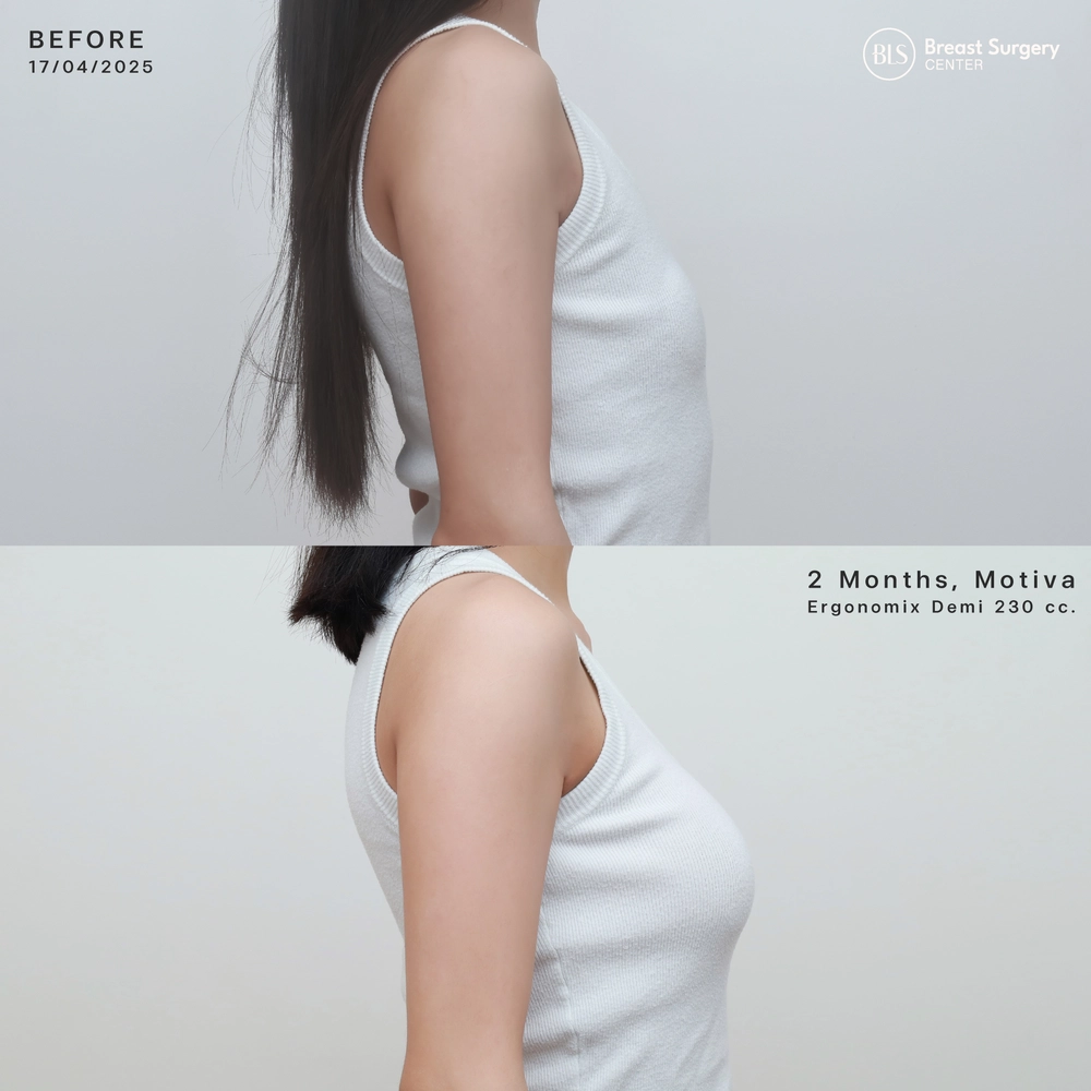 ปัญหาก่อนทำ หน้าอกเล็ก และเริ่มมีความหย่อนคล้อยหลังเสริมหน้าอกซิลิโคน Motiva Ergonomix Demi 230 cc ช่วยเพิ่มขนาดหน้าอก รูปร่างได้สัดส่วนมากขึ้น หน้าอกทรงสวย ผลลัพธ์เป็นธรรมชาติ
