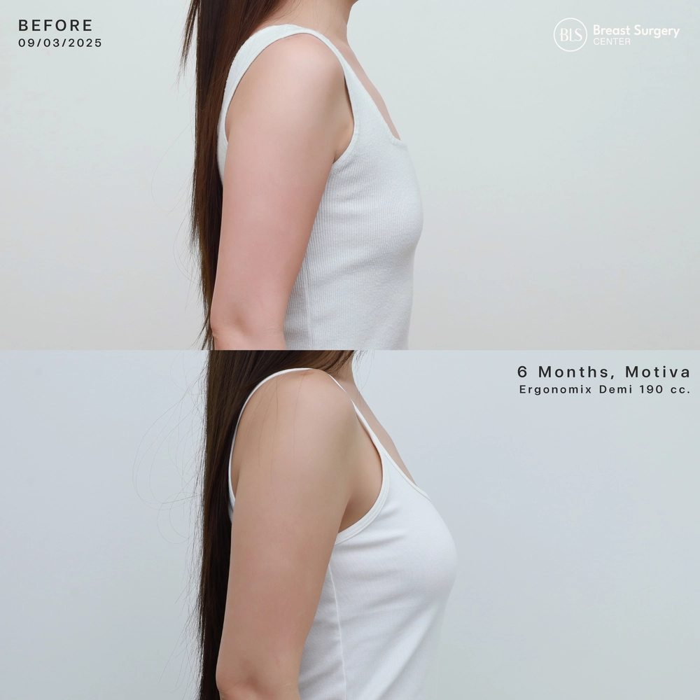 ปัญหาก่อนทำ เนื้อหน้าอกน้อย ดูอกแบน แต่งตัวยาก หลังเสริมหน้าอก ซิลิโคน Motiva Ergonomix Demi 190 cc ช่วยให้มีเนินอกสวยๆ ทรงคุณหนู ดูละมุนและเป็นธรรมชาติ