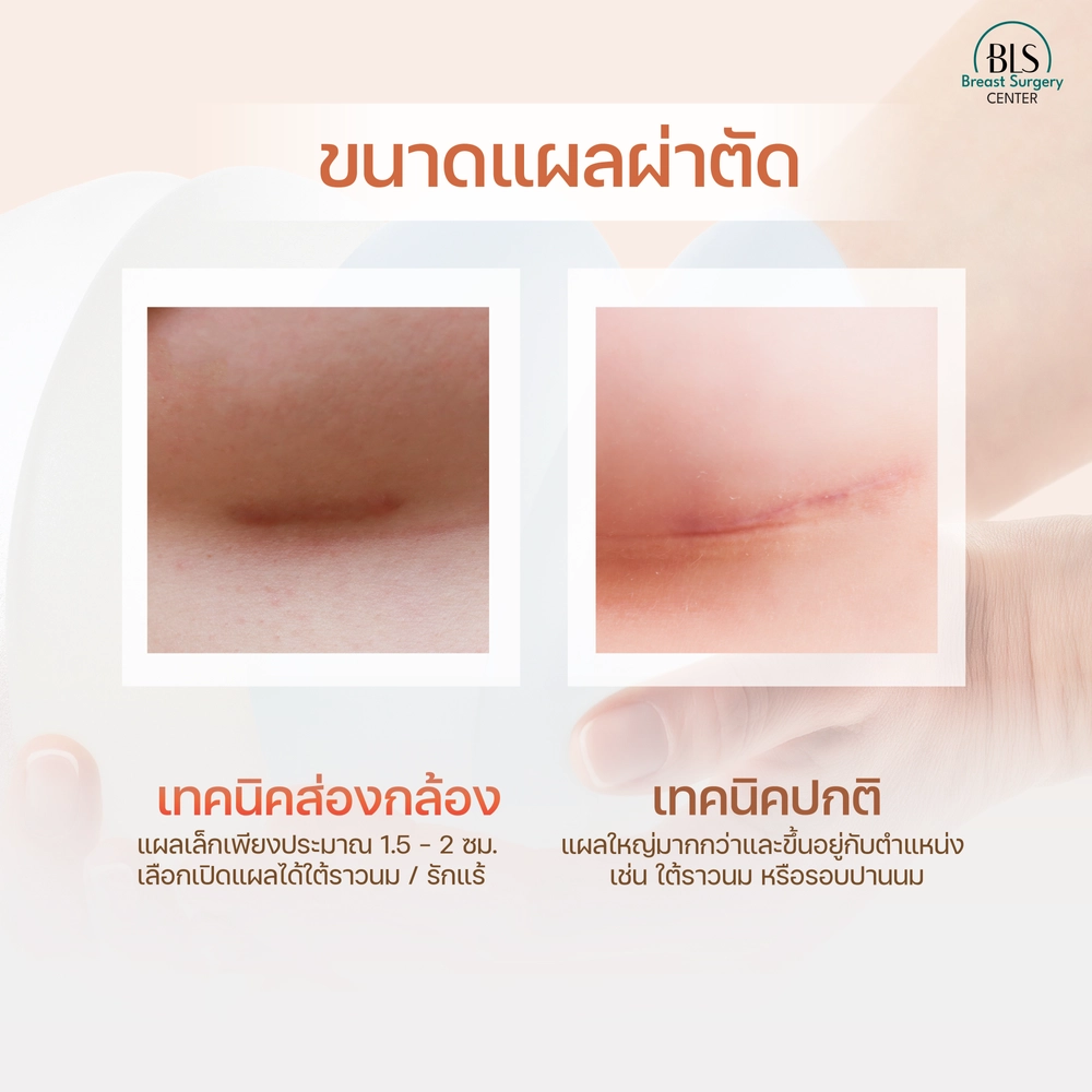 เสริมหน้าอกที่ไหนดี