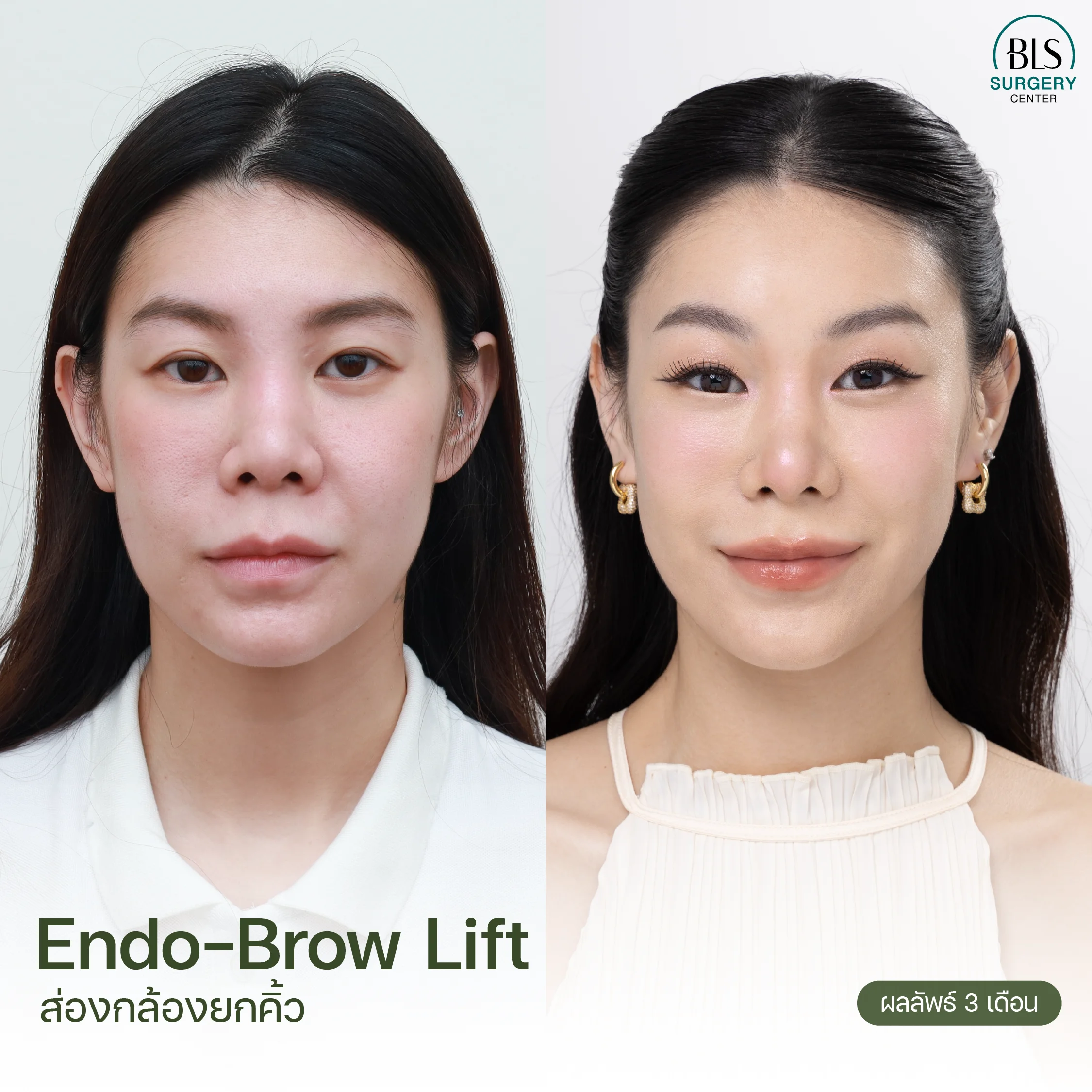 รีวิวส่องกล้องยกคิ้ว Endotine ที่ BLS