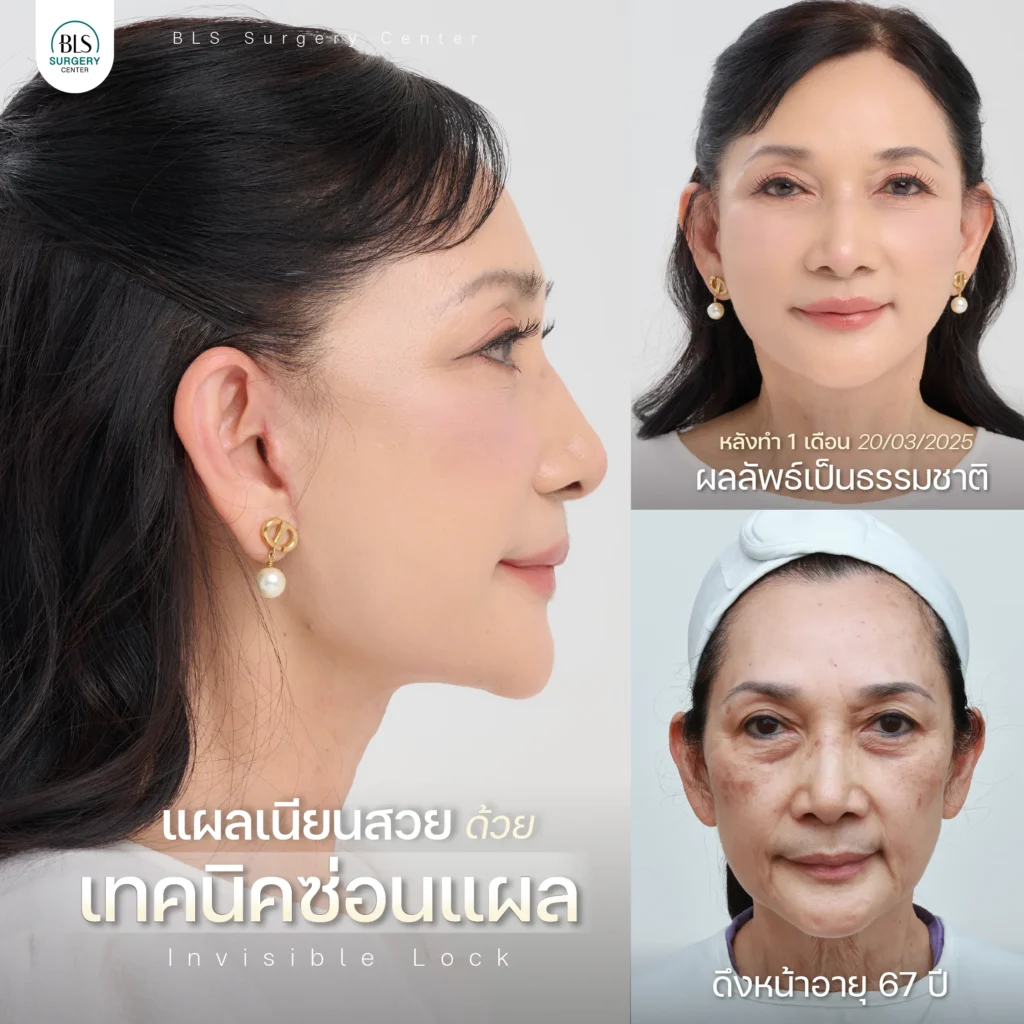 เทคนิคซ่อนแผล BLS แผลเล็ก