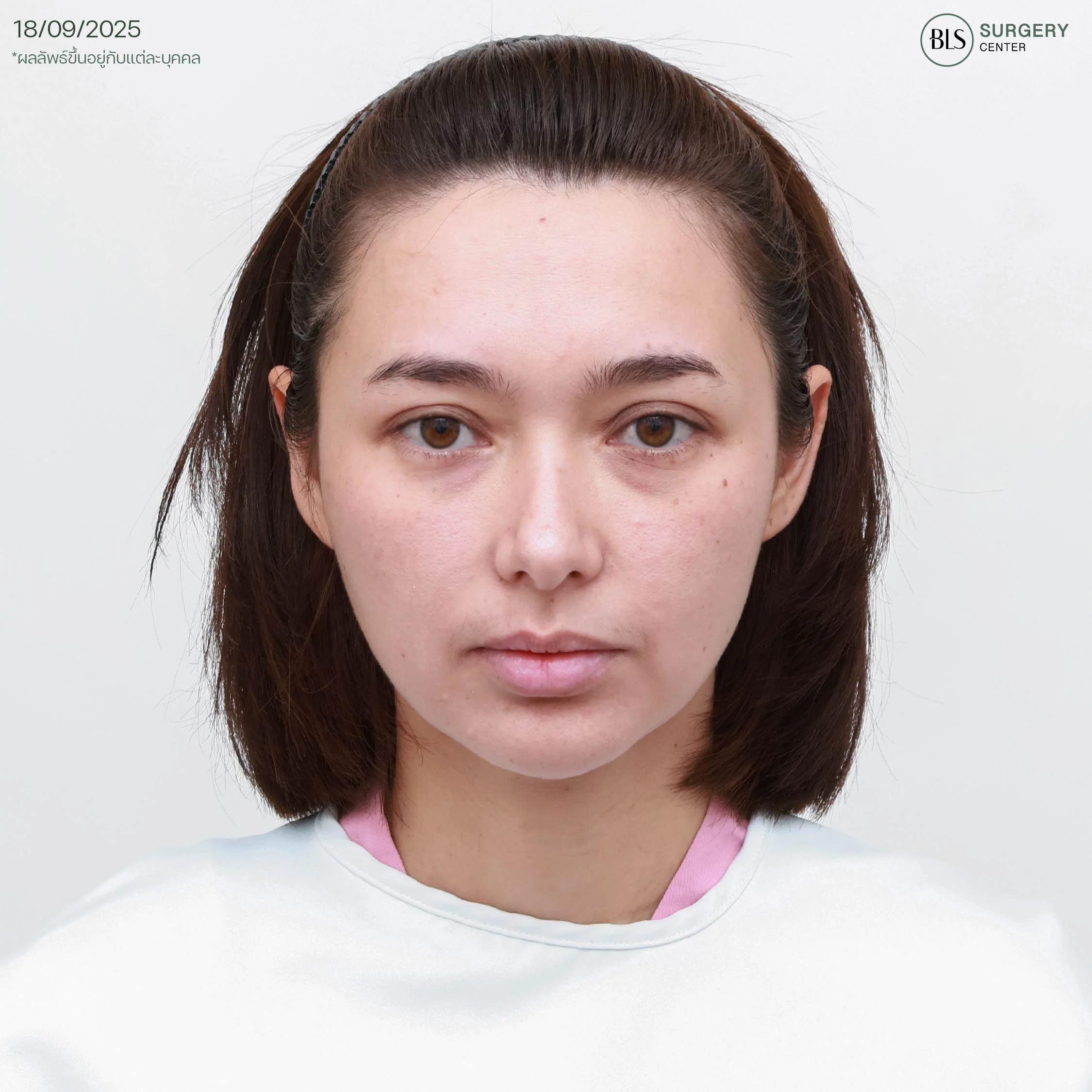 ก่อนทำ Endo-Brow Lift ส่องกล้องยกคิ้ว คิ้วตก หางตาตก หน้าดูเศร้า ดูดุ