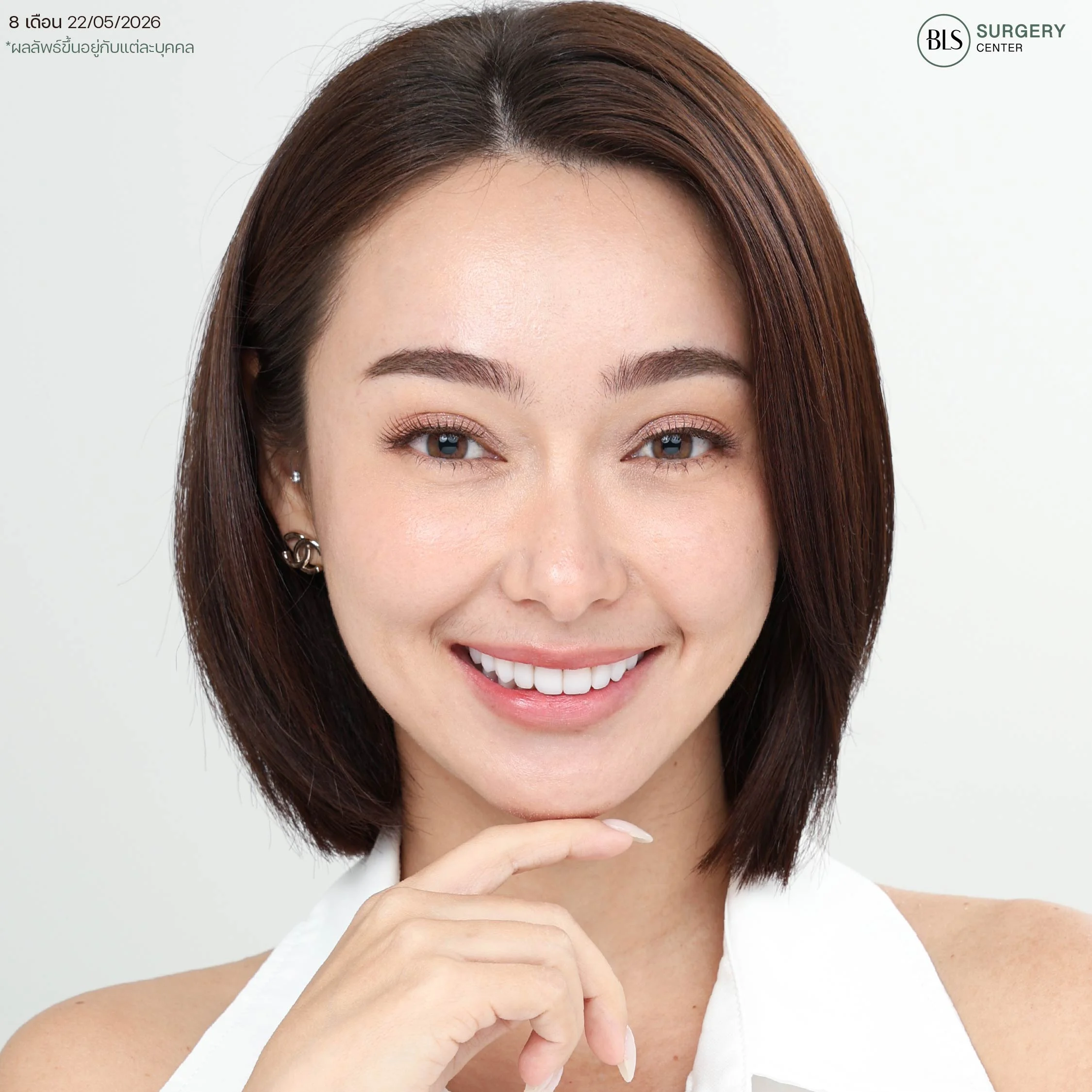 หลังทำ Endo-Brow Lift ส่องกล้องยกคิ้ว