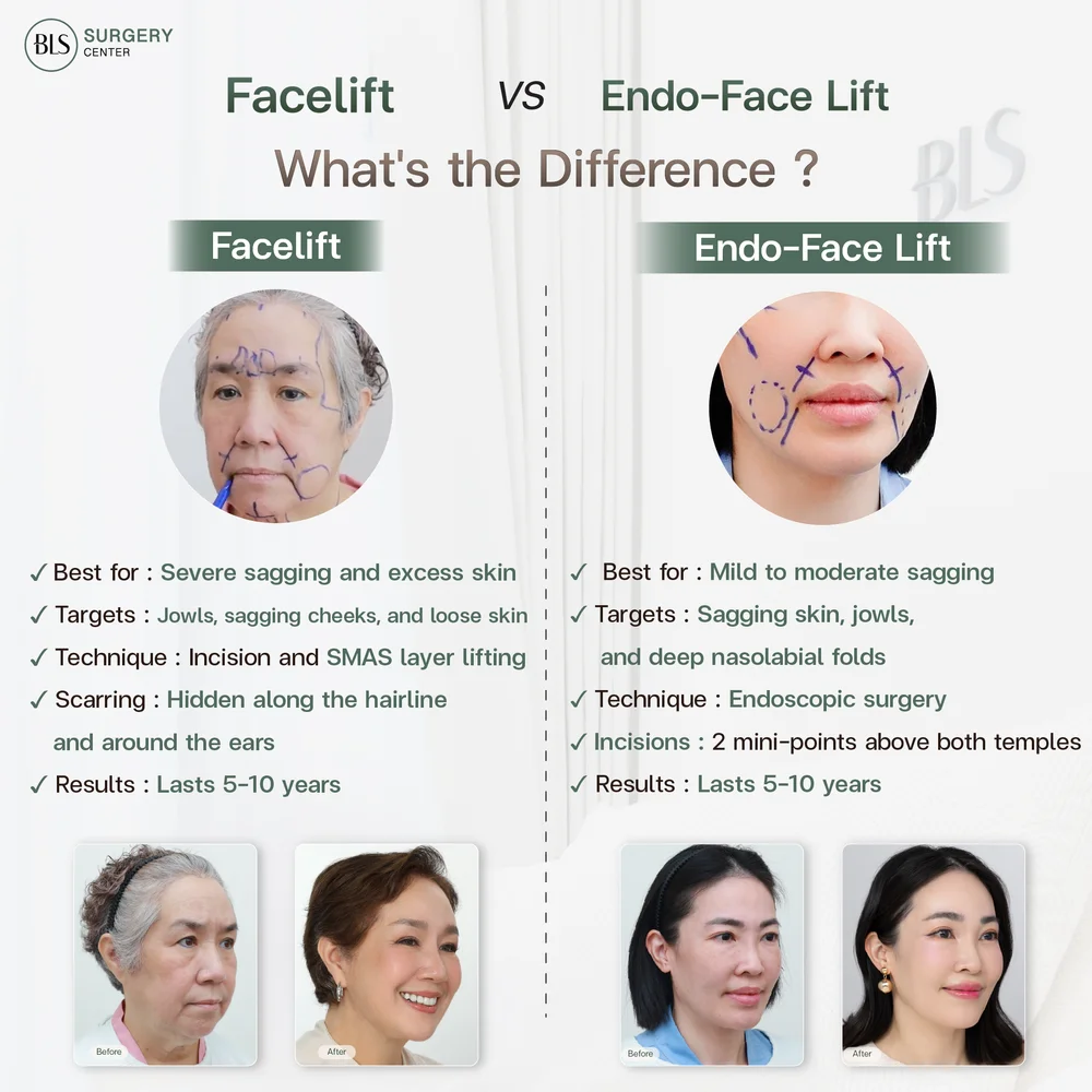 ส่องกล้อง ดึงหน้า Endo-Face-Lift กับ Facelift ยกกระชับใบหน้า ต่างกันอย่างไร?