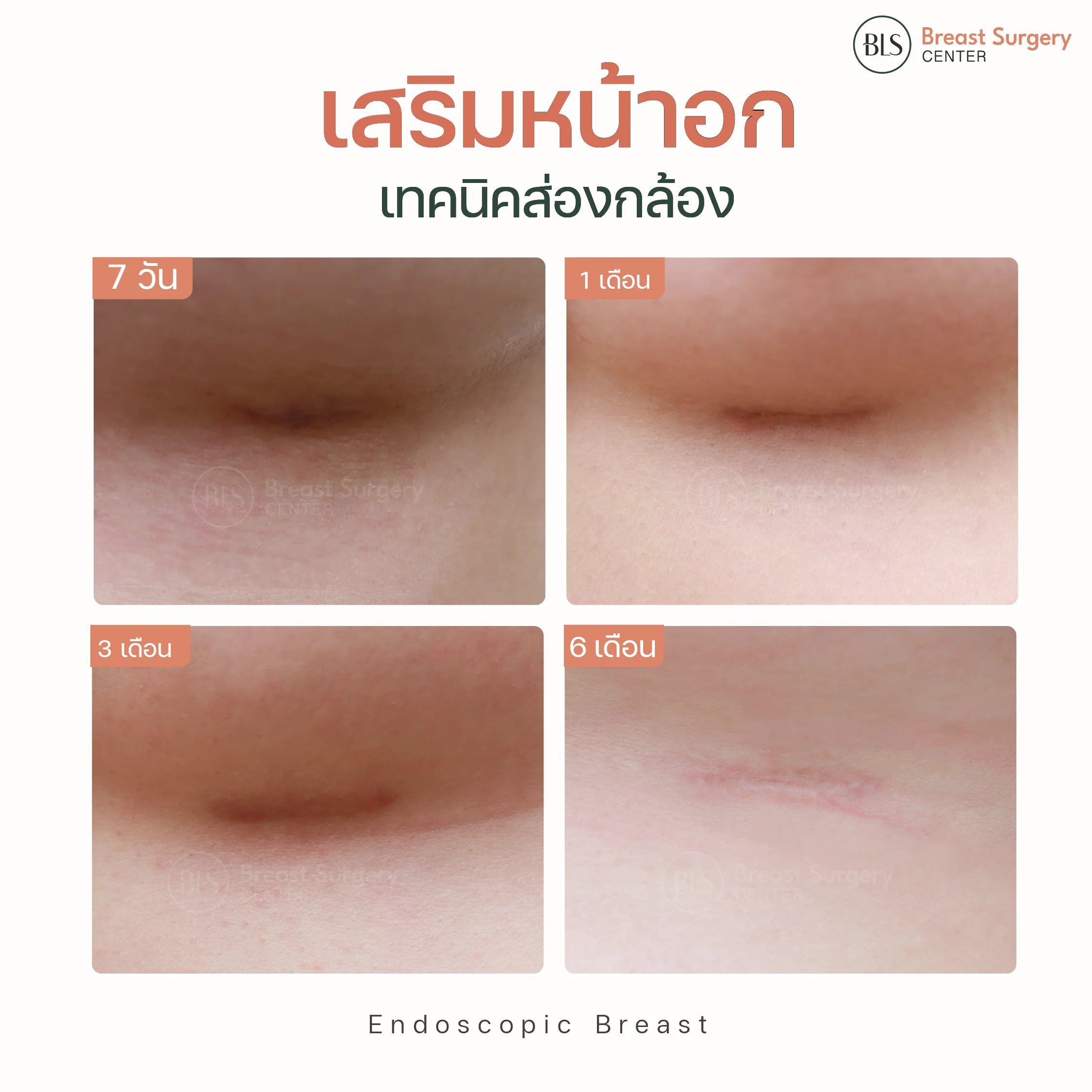 ส่องกล้องเสริมหน้าอก ที่ BLS แผลเล็ก สีแผลจางแทบไม่เห็นแผล