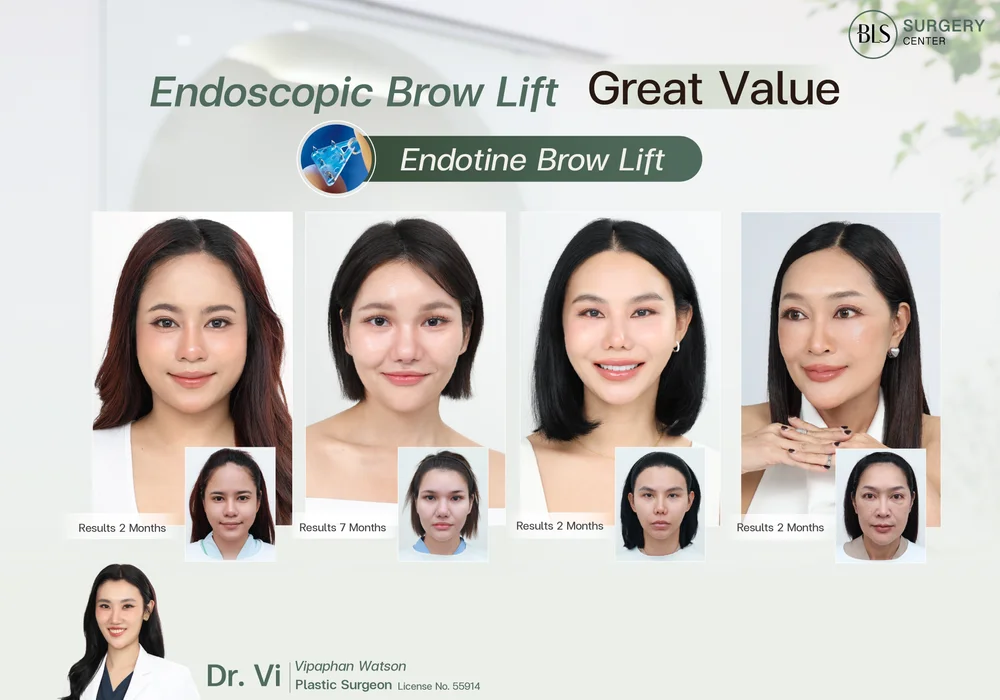 Endoscopic Brow Lift — Great Value | Endotine Brow Lift at BLS Surgery Center
