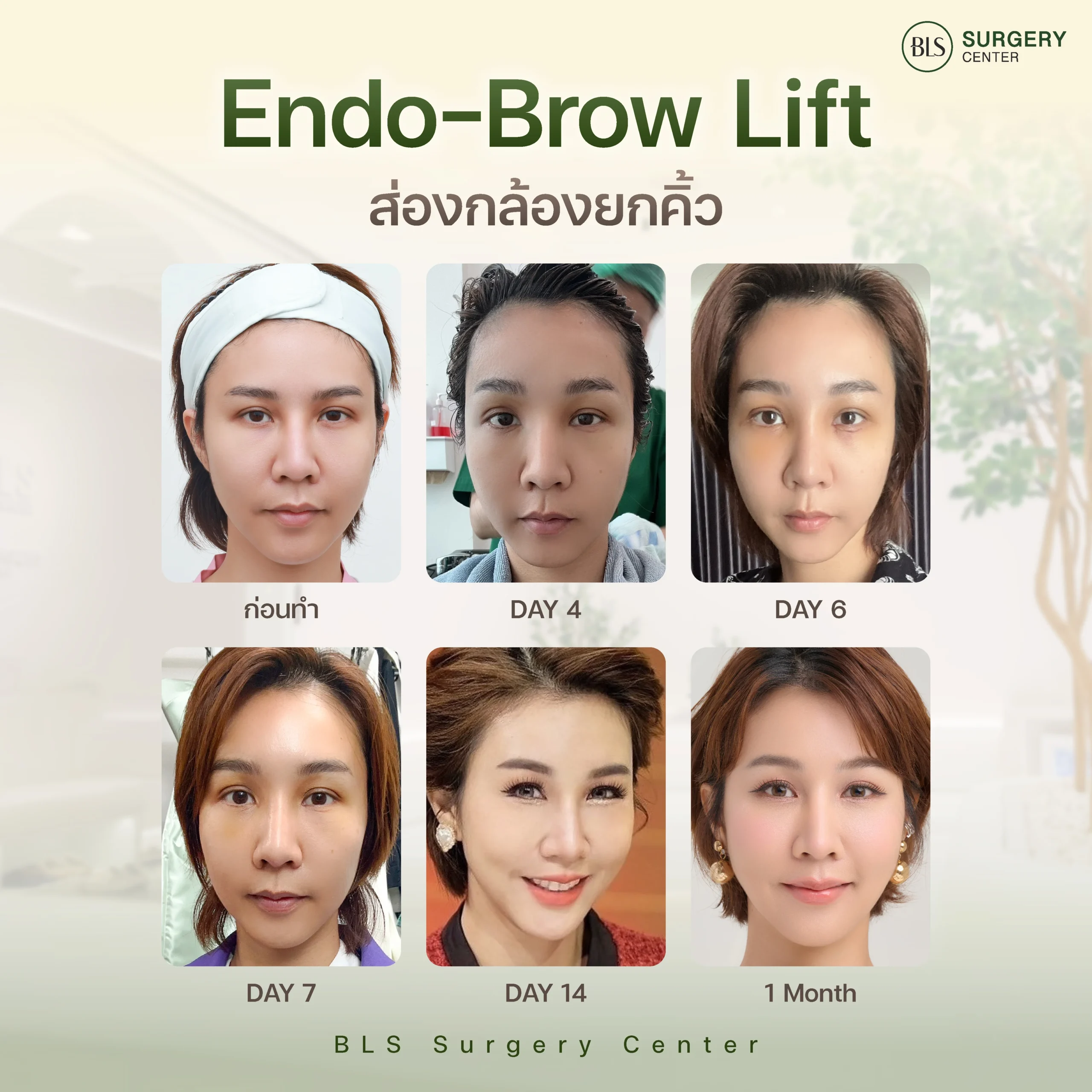 ระยะการเข้าที่ หลังยกคิ้ว Endotine (Endo-Brow Lift)