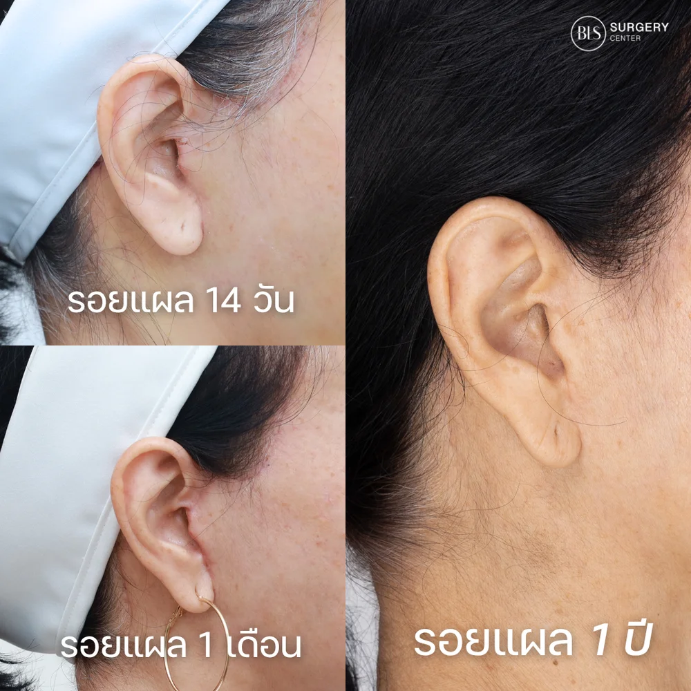 ดึงหน้า รีวิวสวยๆ จากคนไข้ BLS Surgery Center