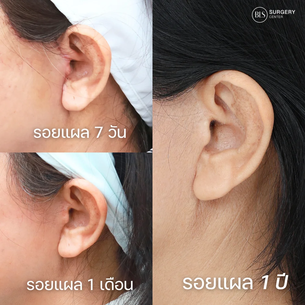 ดึงหน้า รีวิวสวยๆ จากคนไข้ BLS Surgery Center