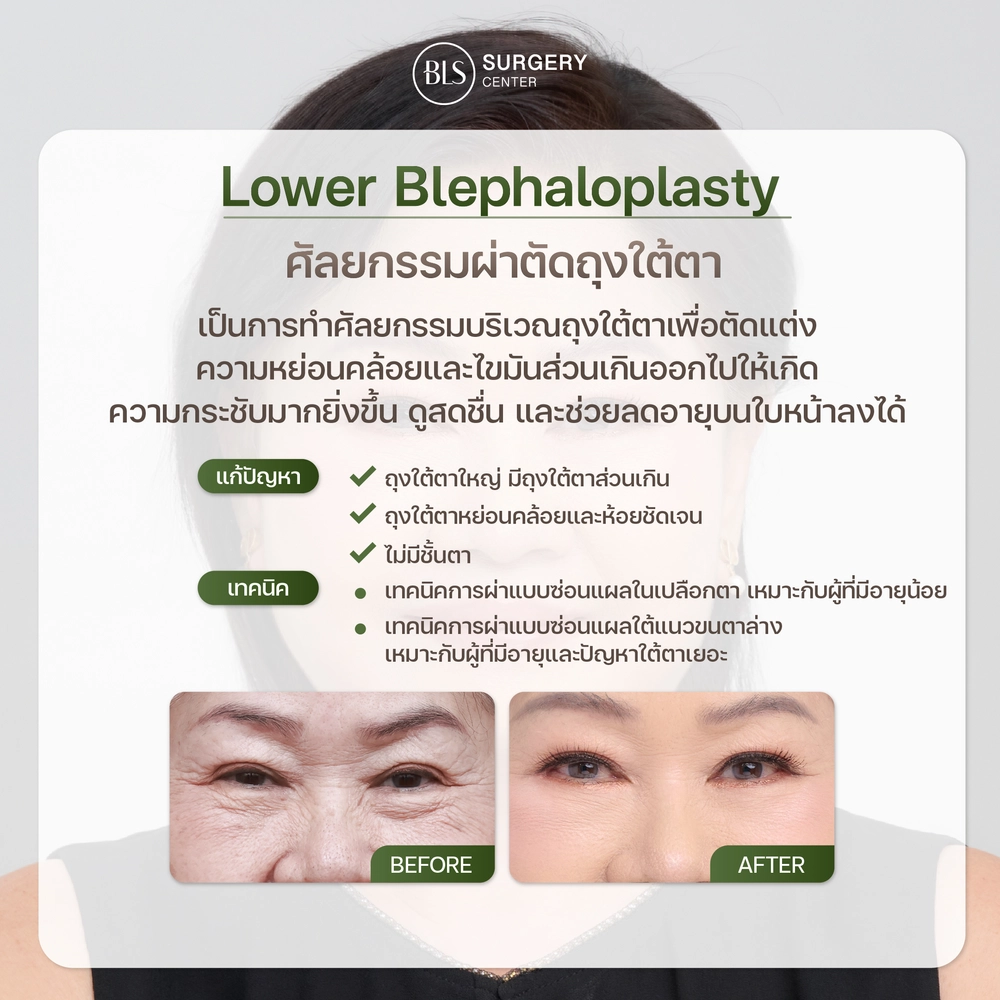 Lower Blepharoplasty