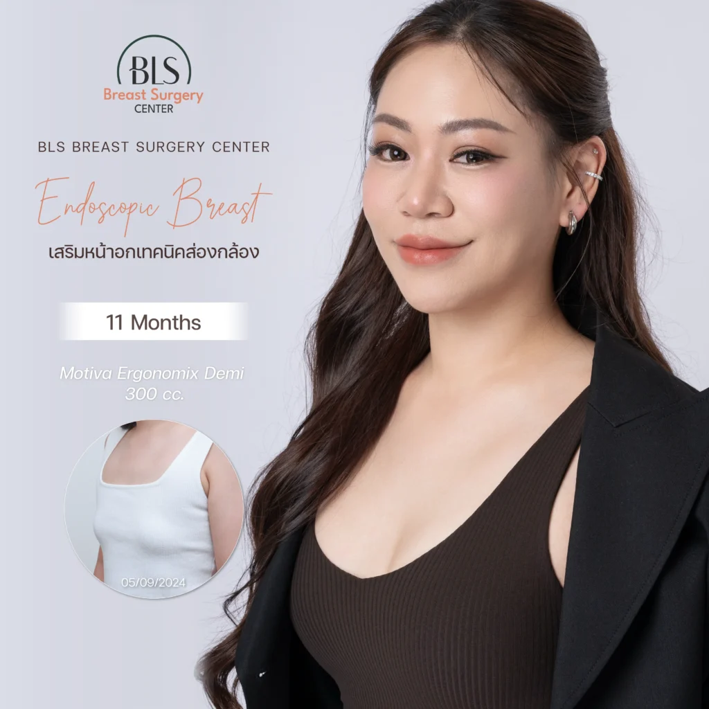 ผลลัพธ์หลังเสริมหน้าอก เทคนิคส่องกล้อง