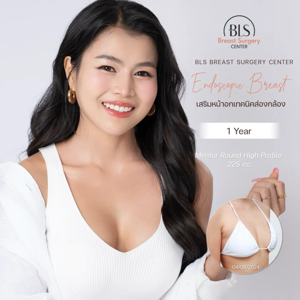 ผลลัพธ์หลังเสริมหน้าอก เทคนิคส่องกล้อง