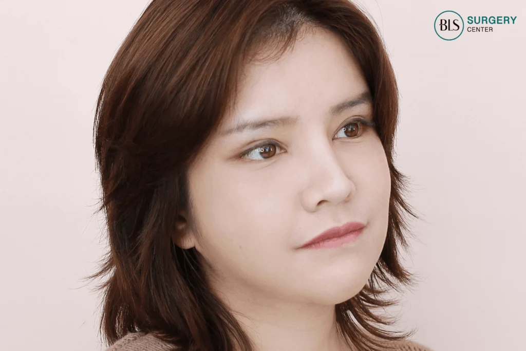 After Foxy Eyes – lifted brows and outer corners – 14 days, outer corners sharper and more beautiful