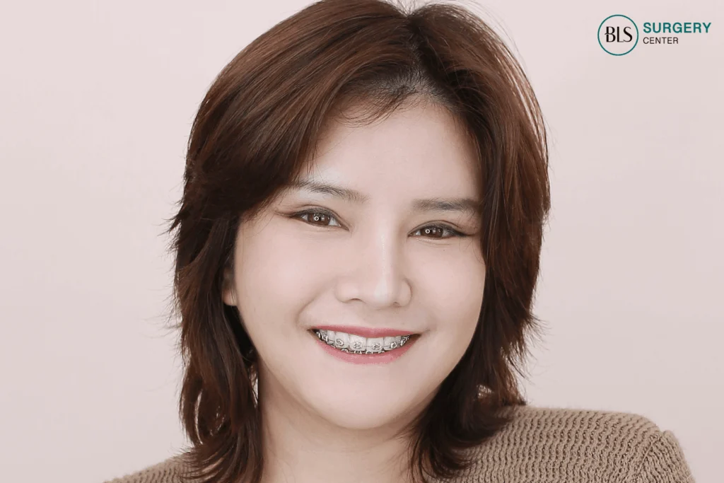 After Foxy Eyes – lifted brows and outer corners – 14 days, no visible scars