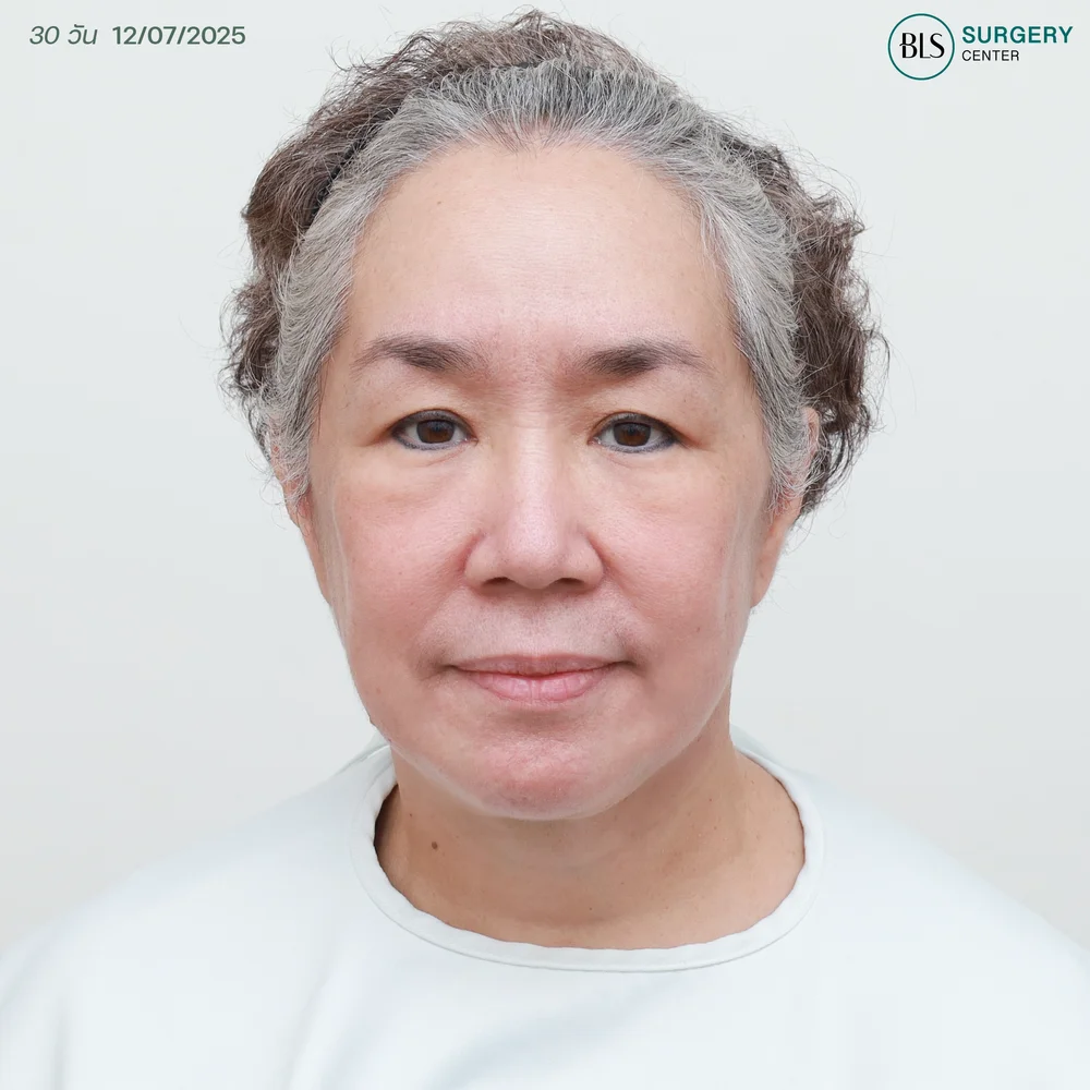 ดึงหน้าอยู่ได้กี่ปี (รีวิวแม่เขื่อน ภัทรดนัย)